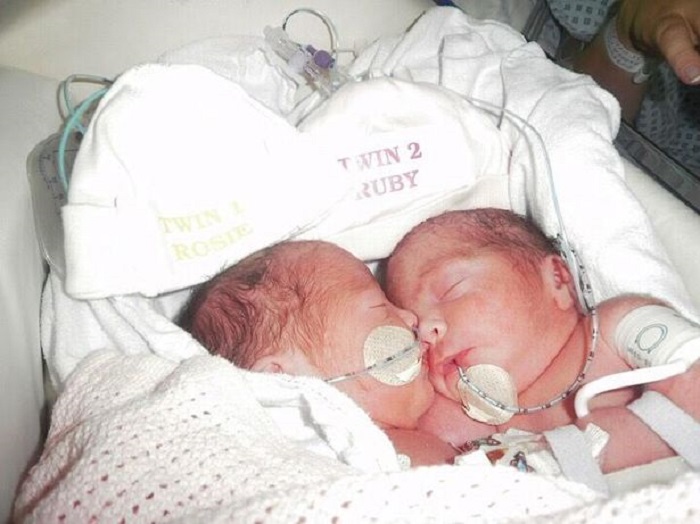 В 2012 году женщина родила сиамских близнецов, которых сразу же было решено разделить. Как они выглядят через 7 лет
