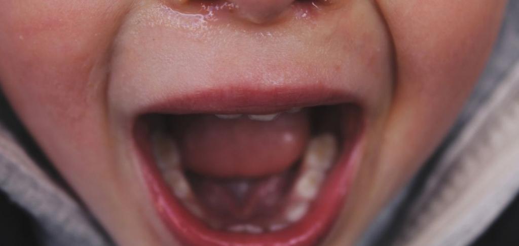 Американские исследователи обнаружили связь между ранней потерей зубов во взрослом возрасте и детскими психологическим травмами