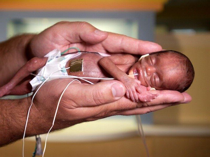 Самая маленькая недоношенная девочка в мире родилась с весом 245 грамм: что с ней сейчас