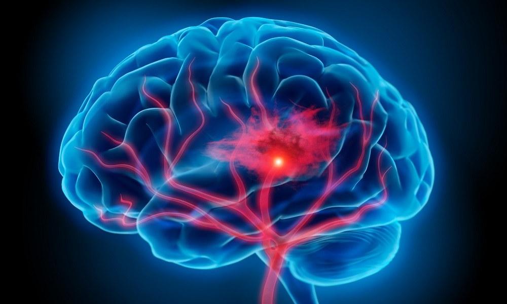 Глутамат "построил" наш мозг. Сможет ли он помочь справиться со склерозом, инсультом и другими его болезнями?