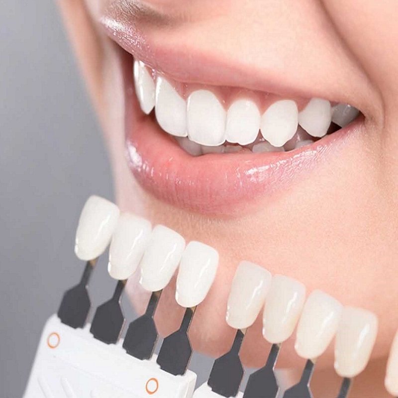 Что важно знать об отбеливании зубов: чтобы зубы не окрашивались после процедуры, втирайте в них вазелин