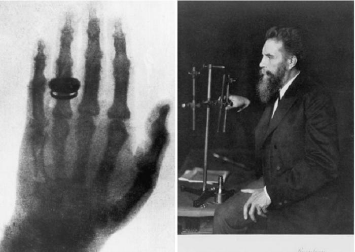Рентгеновские лучи: как открытие, совершенное 125 лет назад, изменило нашу жизнь