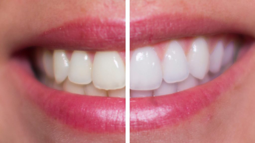 По совету стоматолога сама отбеливаю зубы домашними безопасными способами. Подойдет шалфей, яблочный уксус и другие средства