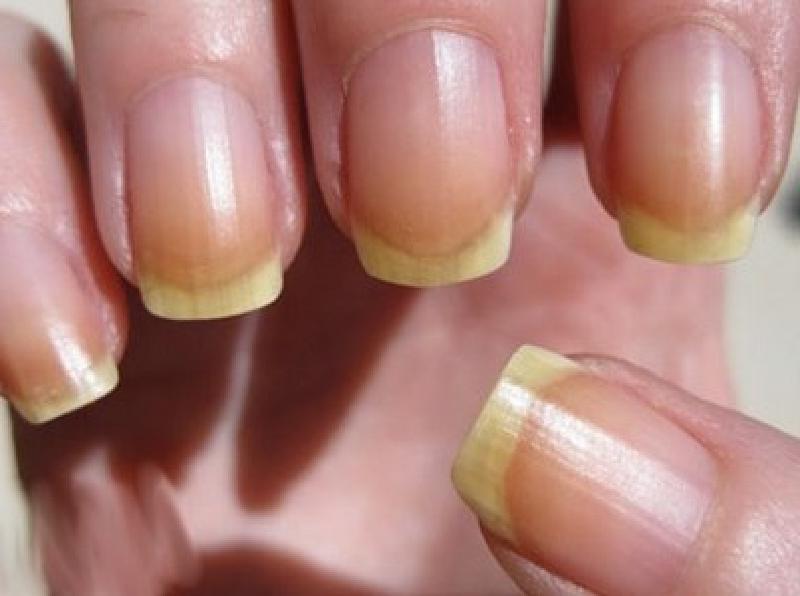 Ногти желтеют или становятся слишком тонкими? Нейл-мастера дали пояснения, когда ногтям требуется отдохнуть от гель-лака
