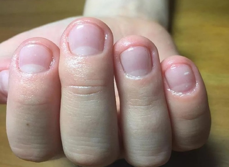 Почему привычка грызть ногти может навредить нашему здоровью