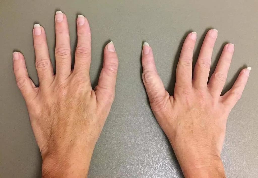 Взгляните на ногти: британский профессор назвал неожиданный симптом перенесенного коронавируса