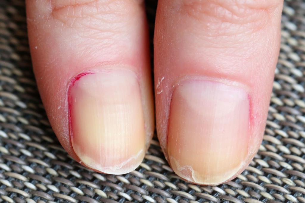 "Тест" на антитела по рукам: эксперты сообщили о "ковидных ногтях"
