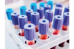 Ранняя диагностика: для чего и как сдают анализ на гликированный гемоглобин