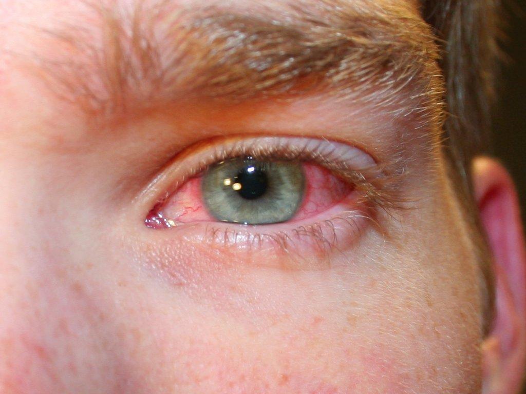 "Красный глаз": причины возникновения заболевания