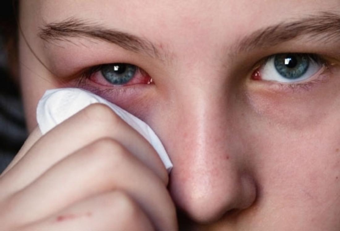 "Красный глаз": причины возникновения заболевания