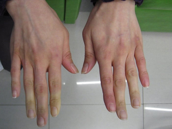 Покалывание в пальцах рук может быть симптомом инсульта, диабета и других заболеваний
