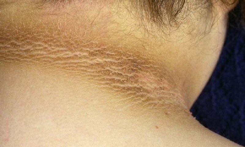 Темная полоса вокруг шеи: тревожный признак тяжелой болезни, который нельзя игнорировать
