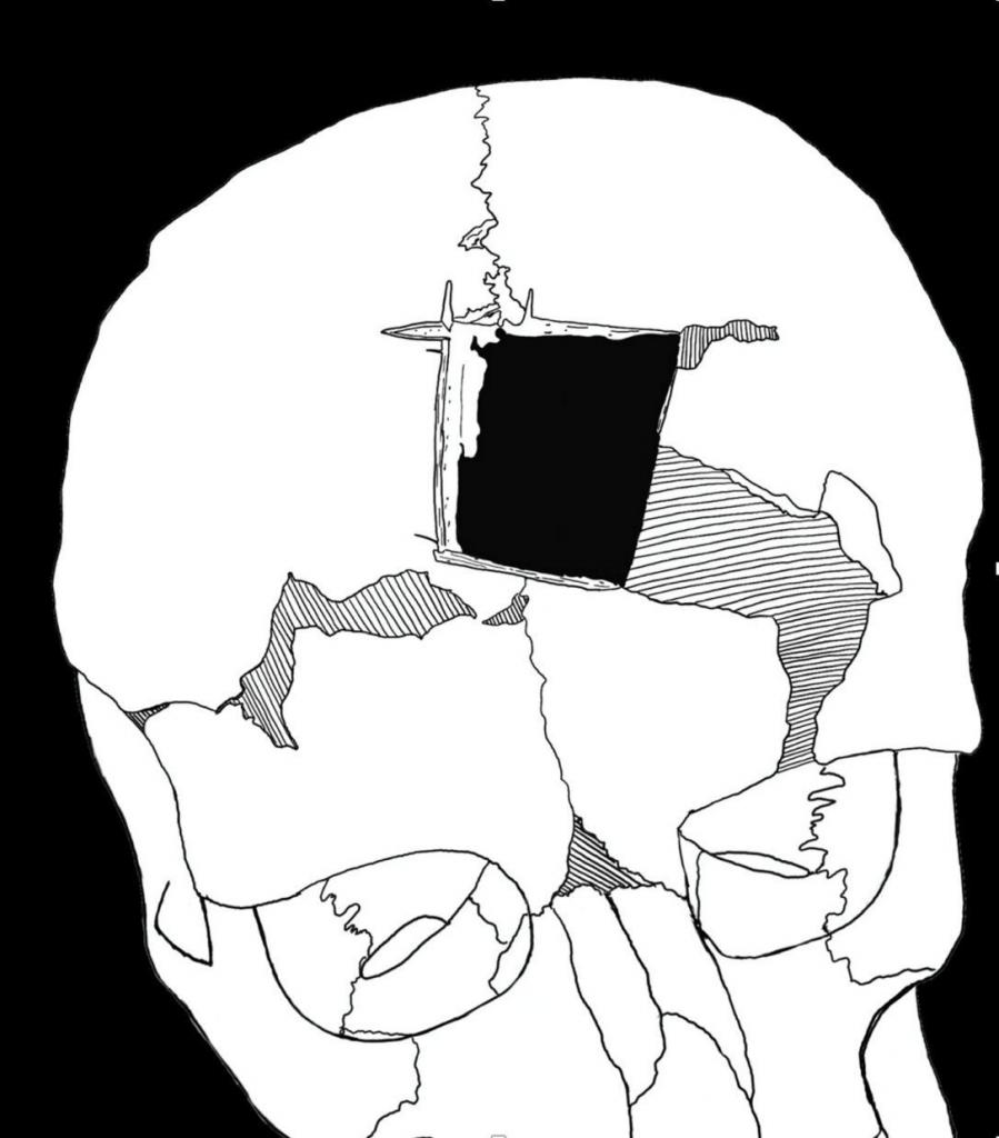 Пустяк-операция: трепанацию черепа умели делать тысячи лет назад, и люди выживали