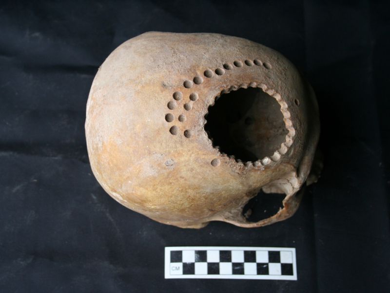 Пустяк-операция: трепанацию черепа умели делать тысячи лет назад, и люди выживали
