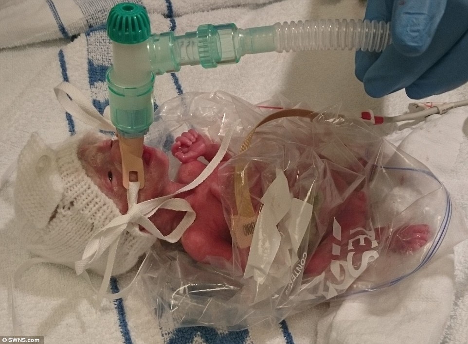Недоношенная малышка, выжившая в пакете из-под сэндвича: вот как она выглядит три года спустя