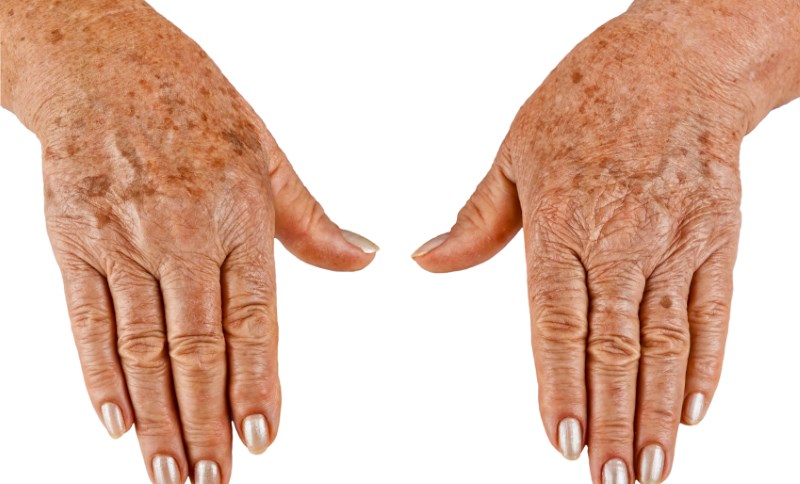 Темные пятна на руках старых людей: причины появления, симптомы, лечение