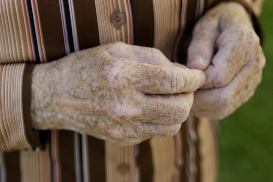 Темные пятна на руках старых людей: причины появления, симптомы, лечение