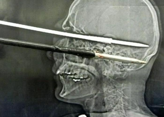 Рентген в шоке: самые странные предметы, застрявшие в теле человека