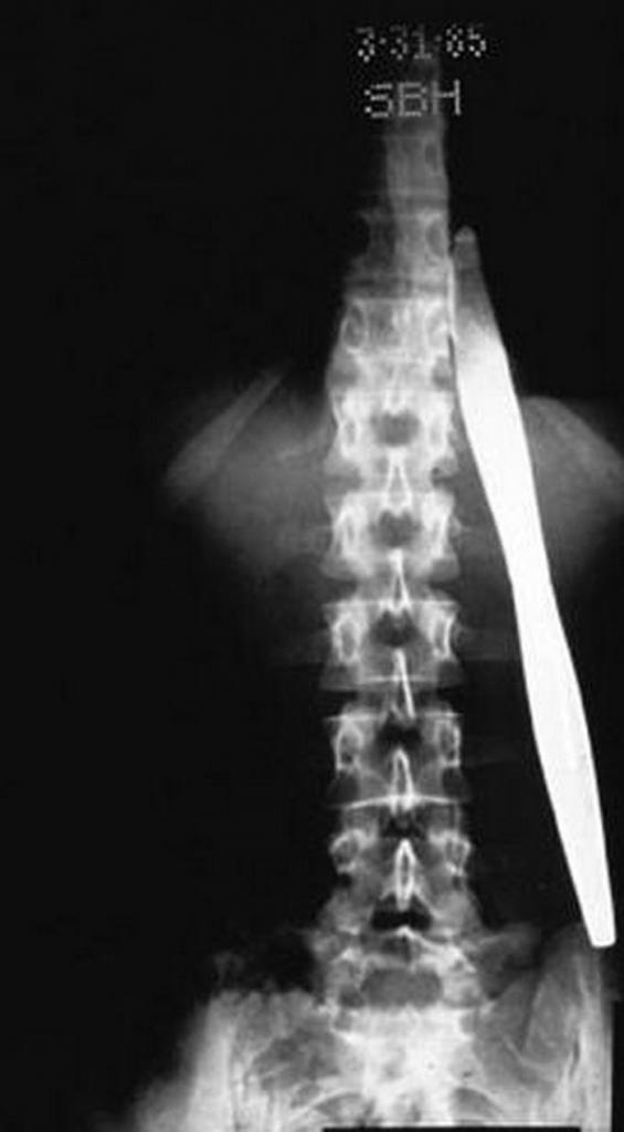 Рентген в шоке: самые странные предметы, застрявшие в теле человека
