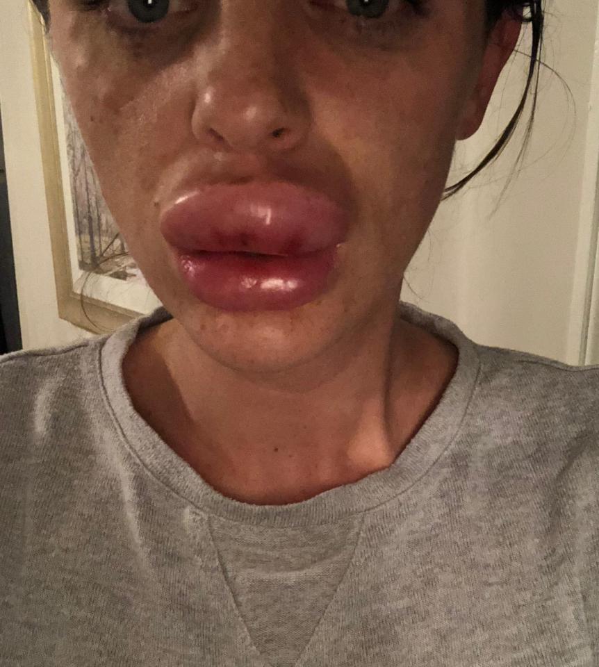 Последствия за «красоту»: девушка решила увеличить губы и доверилась мошенникам