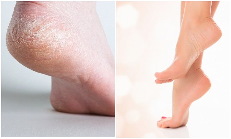 Гладкие и мягкие пяточки: как вернуть здоровье коже на ступнях без усилий и лишних затрат