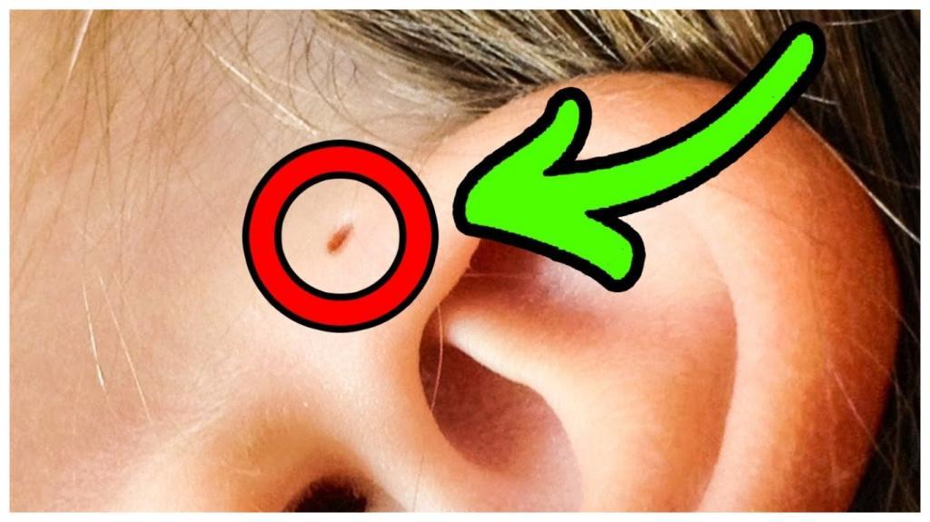 Почему некоторые люди рождаются с маленькими отверстиями возле ушей: научная гипотеза
