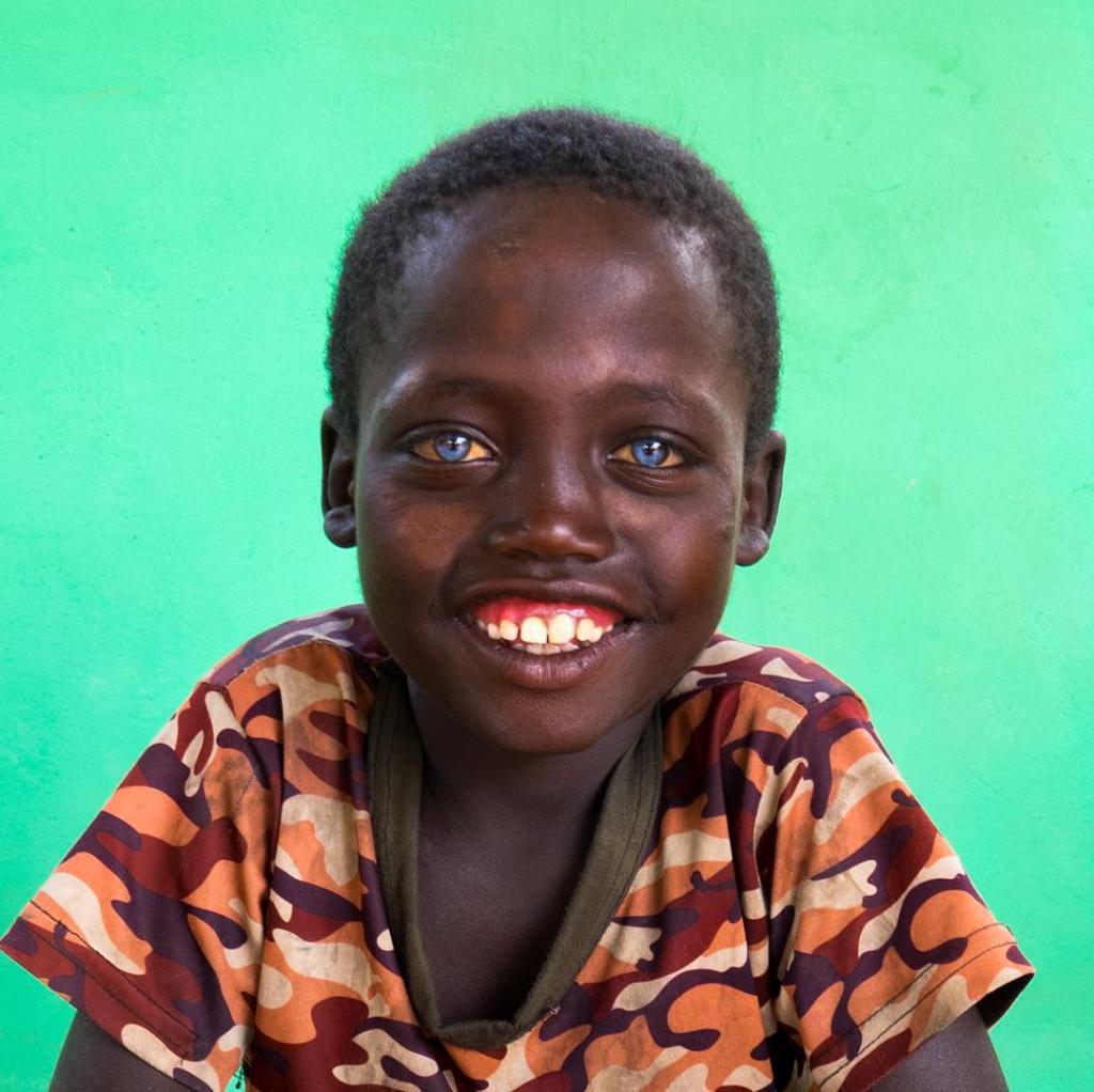 Мальчик из Эфиопии удивляет окружающих глазами небесного цвета. Фото