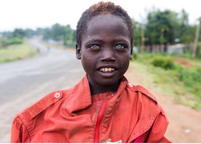 Мальчик из Эфиопии удивляет окружающих глазами небесного цвета. Фото