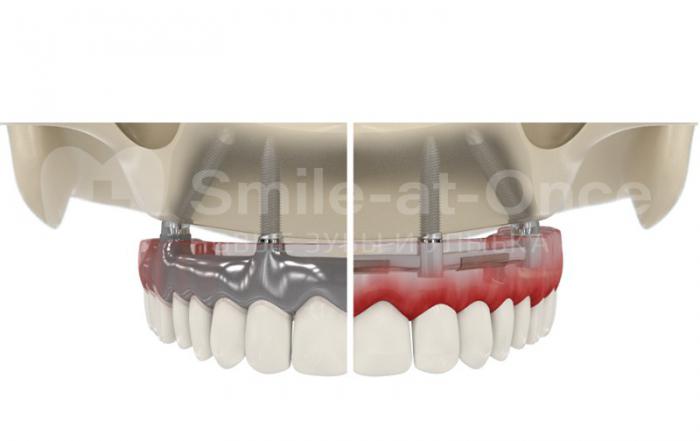имплантация зубов или съемные протезы - какой метод выбрать?