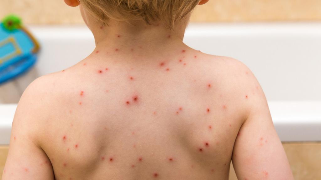 аллергия на груди у ребенка
