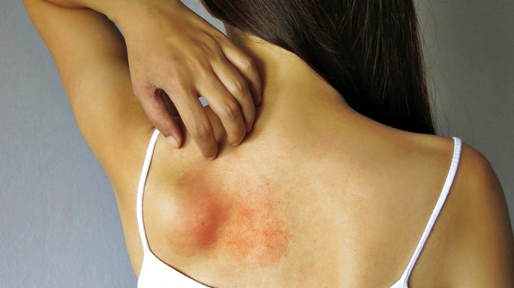 аллергия на груди (спине)