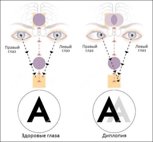 Двоится в одном глазу (монокулярная диплопия): причины и методы лечения