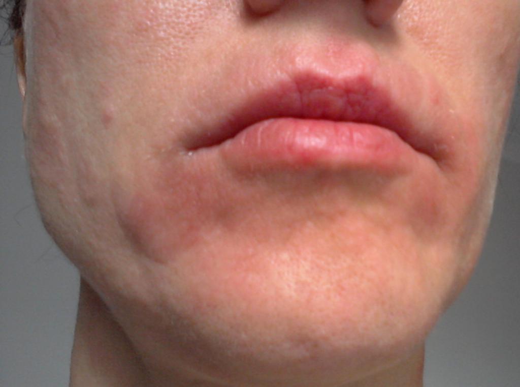 Проявление дерматита на лице