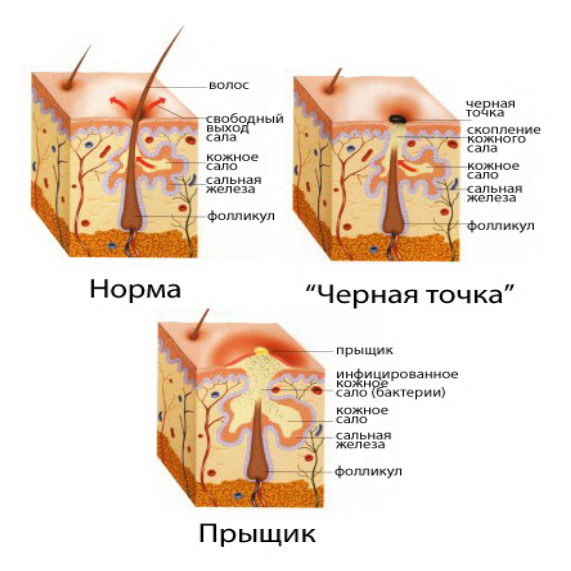 Виды прыщей