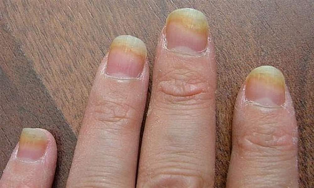 грибковый кератит ногтей