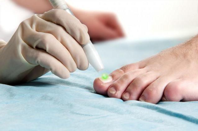 Вросший ноготь: лазерное удаление, причины появления и основные этапы лечения