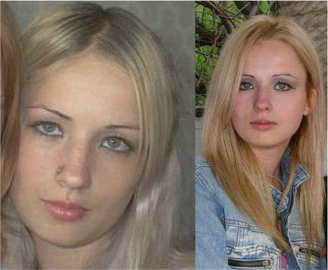 Валерия лукьянова до и после операции
