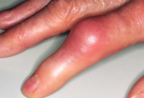 воспаление суставов пальцев рук