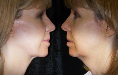 как уменьшить щеки на лице