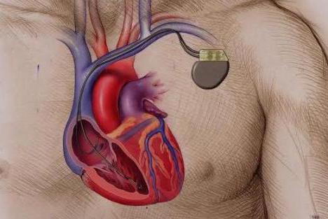 кардиостимулятор сердца