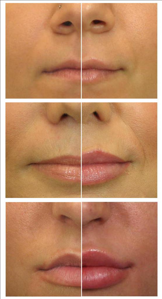 Коррекция губ гиалуроновой кислотой: описание, фото до и после, отзывы