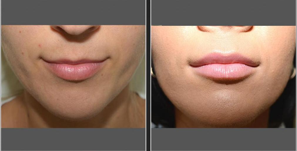 Коррекция губ гиалуроновой кислотой: описание, фото до и после, отзывы