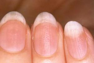Ониходистрофия ногтей: лечение медикаментозными и народными средствами