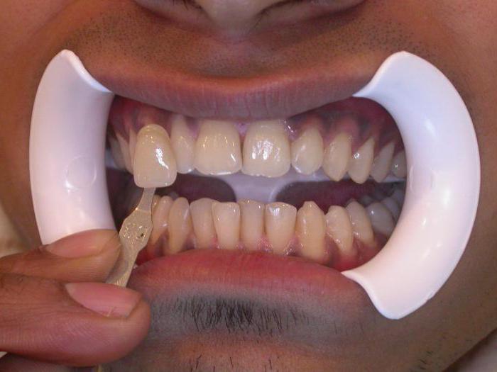 эффективные методы отбеливания зубов