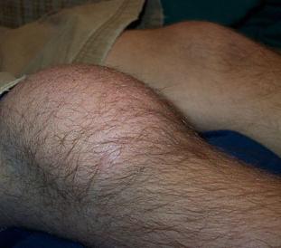 бурсит коленного сустава лечение