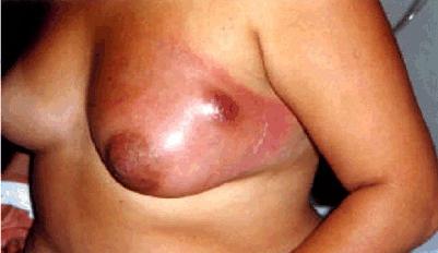 фибрознокистозная мастопатия симптомы