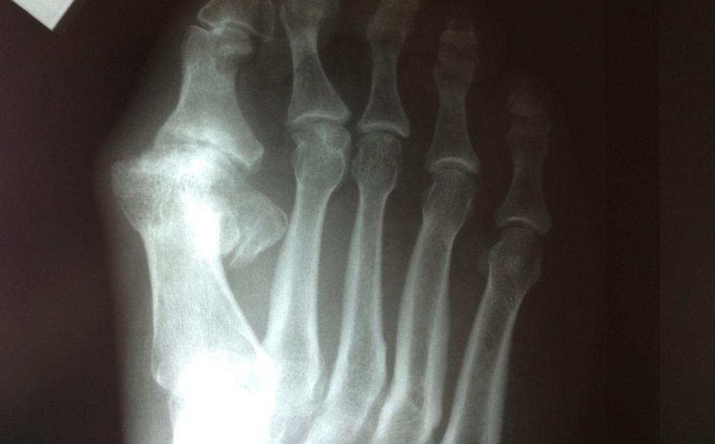 Диагностика артрита пальцев ног