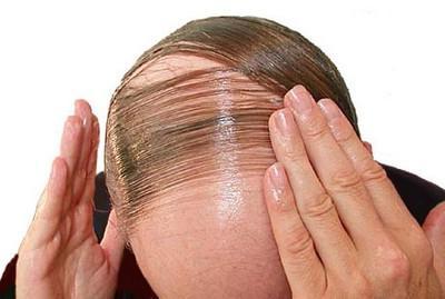 Что делать, если выпали волосы