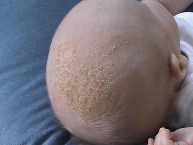 корочки на голове у младенца