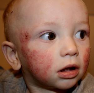 кожные заболевания у детей